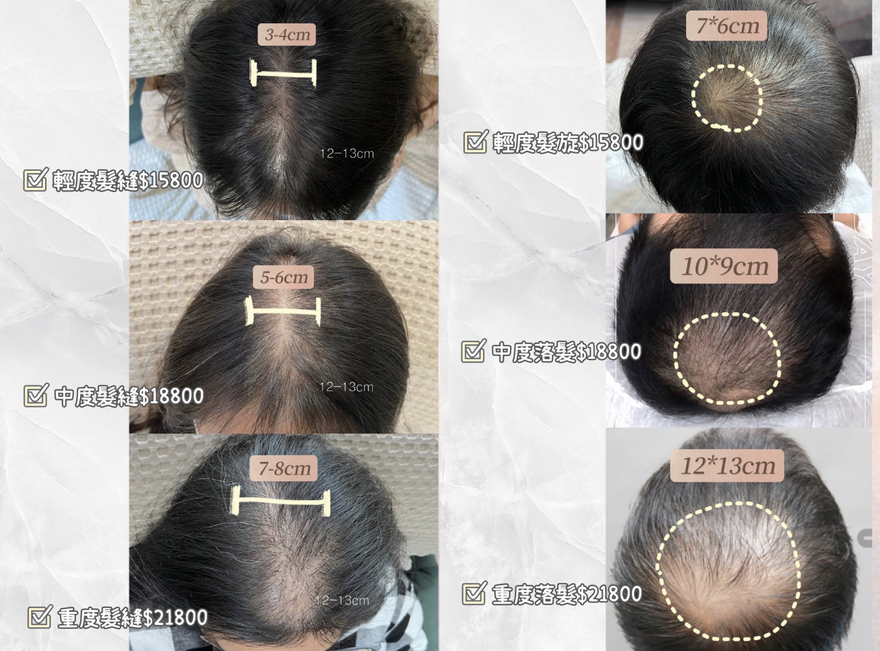 【禿頭落髮救星】不用植髮！無恢復期！3小時擁有茂密髮量～大推台北涵式紋繡的仿毛囊琇密術
