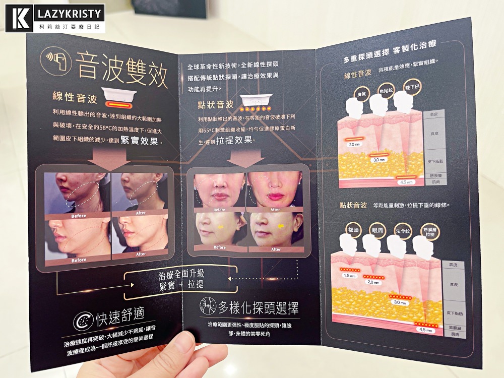 【滾開啦猖狂雙下巴】一招讓你找回消失的輪廓線！Q+立線音波拉提術後1個月多圖全紀錄