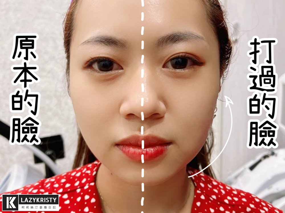 【滾開啦猖狂雙下巴】一招讓你找回消失的輪廓線！Q+立線音波拉提術後1個月多圖全紀錄