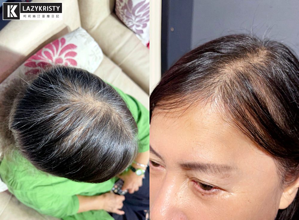 【禿頭落髮救星】不用植髮！無恢復期！3小時擁有茂密髮量～大推台北涵式紋繡的仿毛囊琇密術