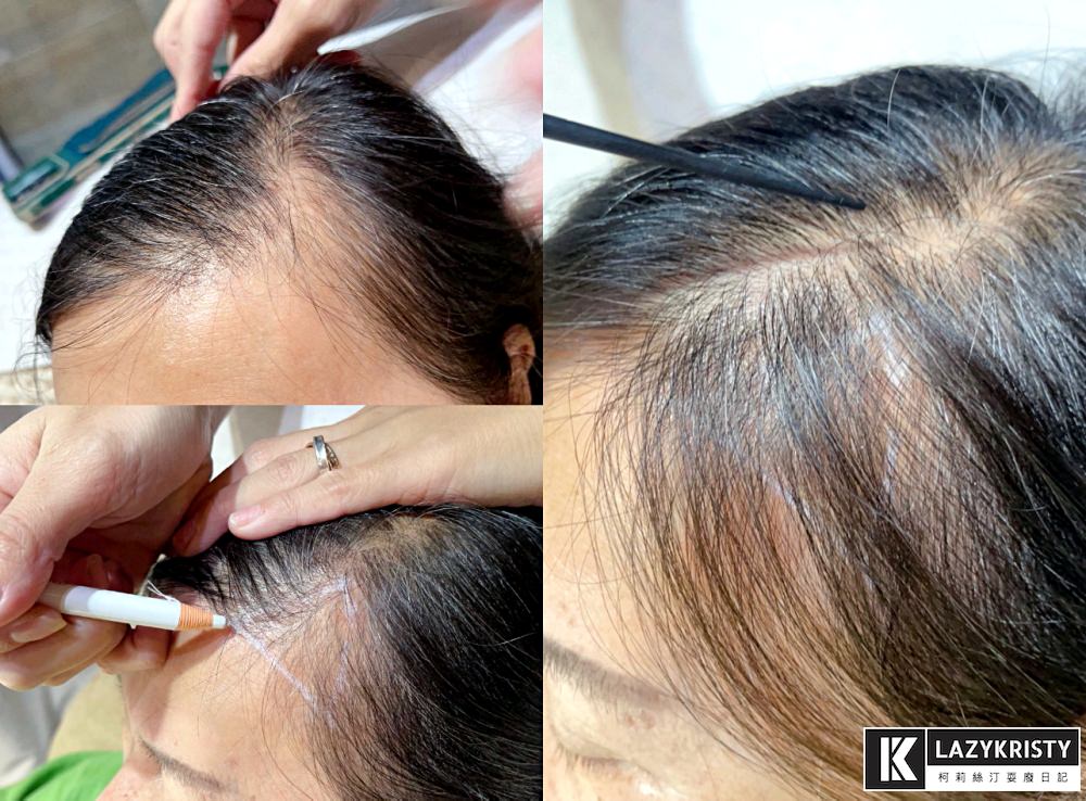 【禿頭落髮救星】不用植髮！無恢復期！3小時擁有茂密髮量～大推台北涵式紋繡的仿毛囊琇密術