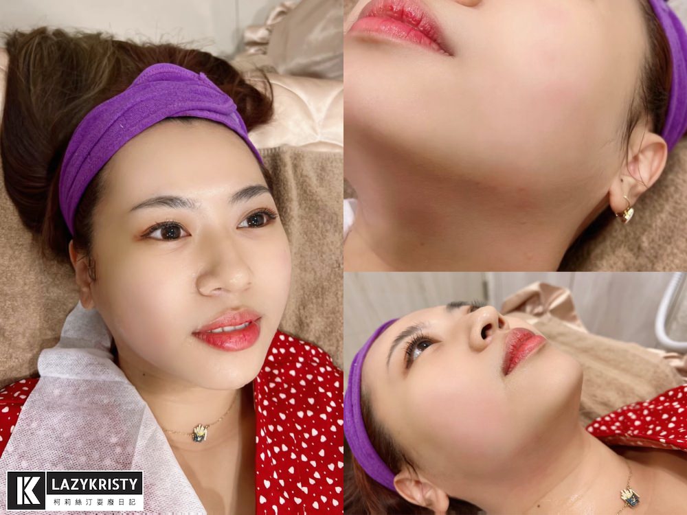 【滾開啦猖狂雙下巴】一招讓你找回消失的輪廓線！Q+立線音波拉提術後1個月多圖全紀錄