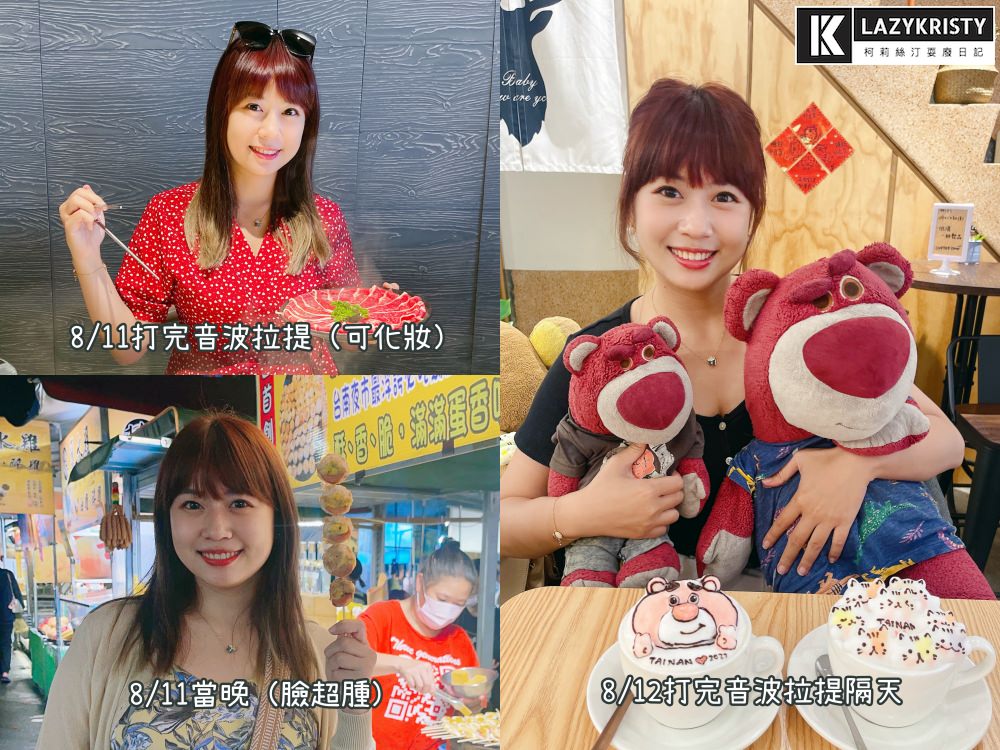 【滾開啦猖狂雙下巴】一招讓你找回消失的輪廓線！Q+立線音波拉提術後1個月多圖全紀錄