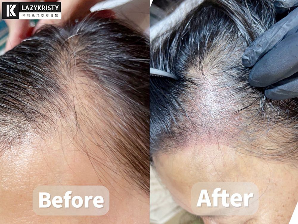 【禿頭落髮救星】不用植髮！無恢復期！3小時擁有茂密髮量～大推台北涵式紋繡的仿毛囊琇密術