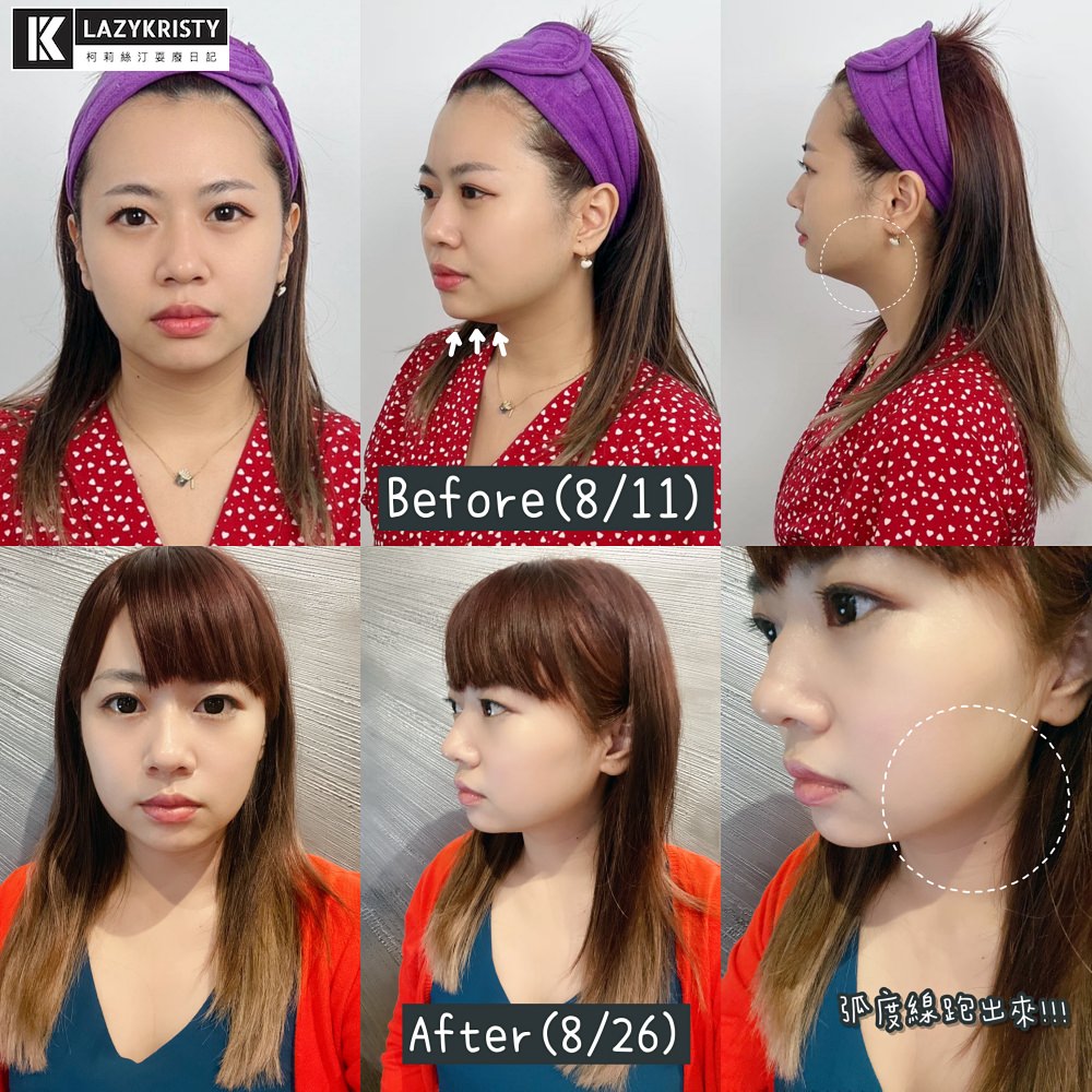 【滾開啦猖狂雙下巴】一招讓你找回消失的輪廓線！Q+立線音波拉提術後1個月多圖全紀錄