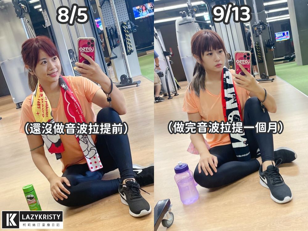 【滾開啦猖狂雙下巴】一招讓你找回消失的輪廓線！Q+立線音波拉提術後1個月多圖全紀錄