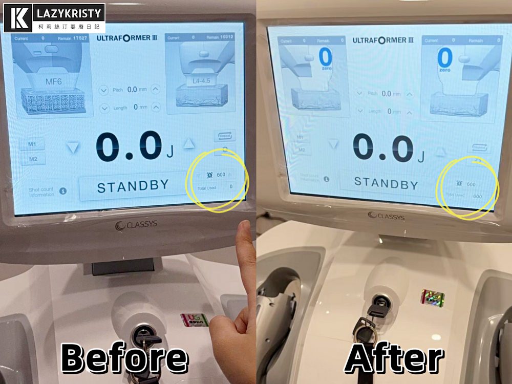 【輪廓線回來啦】第三代海芙音波超有感!拉提緊實一次搞定~台中豐原日曦美學診所推薦 - 第19張圖 【輪廓線回來啦】第三代海芙音波超有感!拉提緊實一次搞定~台中豐原日曦美學診所推薦