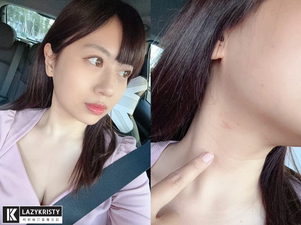 【輪廓線回來啦】第三代海芙音波超有感!拉提緊實一次搞定~台中豐原日曦美學診所推薦 - 第22張圖 【輪廓線回來啦】第三代海芙音波超有感!拉提緊實一次搞定~台中豐原日曦美學診所推薦