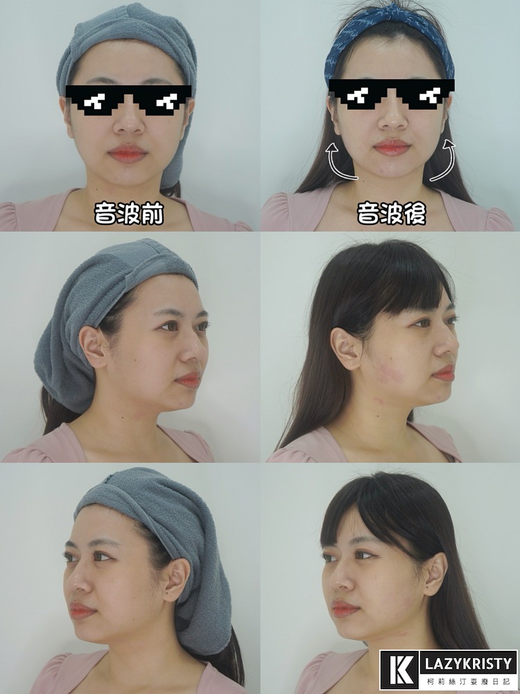 【輪廓線回來啦】第三代海芙音波超有感!拉提緊實一次搞定~台中豐原日曦美學診所推薦 - 第21張圖 【輪廓線回來啦】第三代海芙音波超有感!拉提緊實一次搞定~台中豐原日曦美學診所推薦