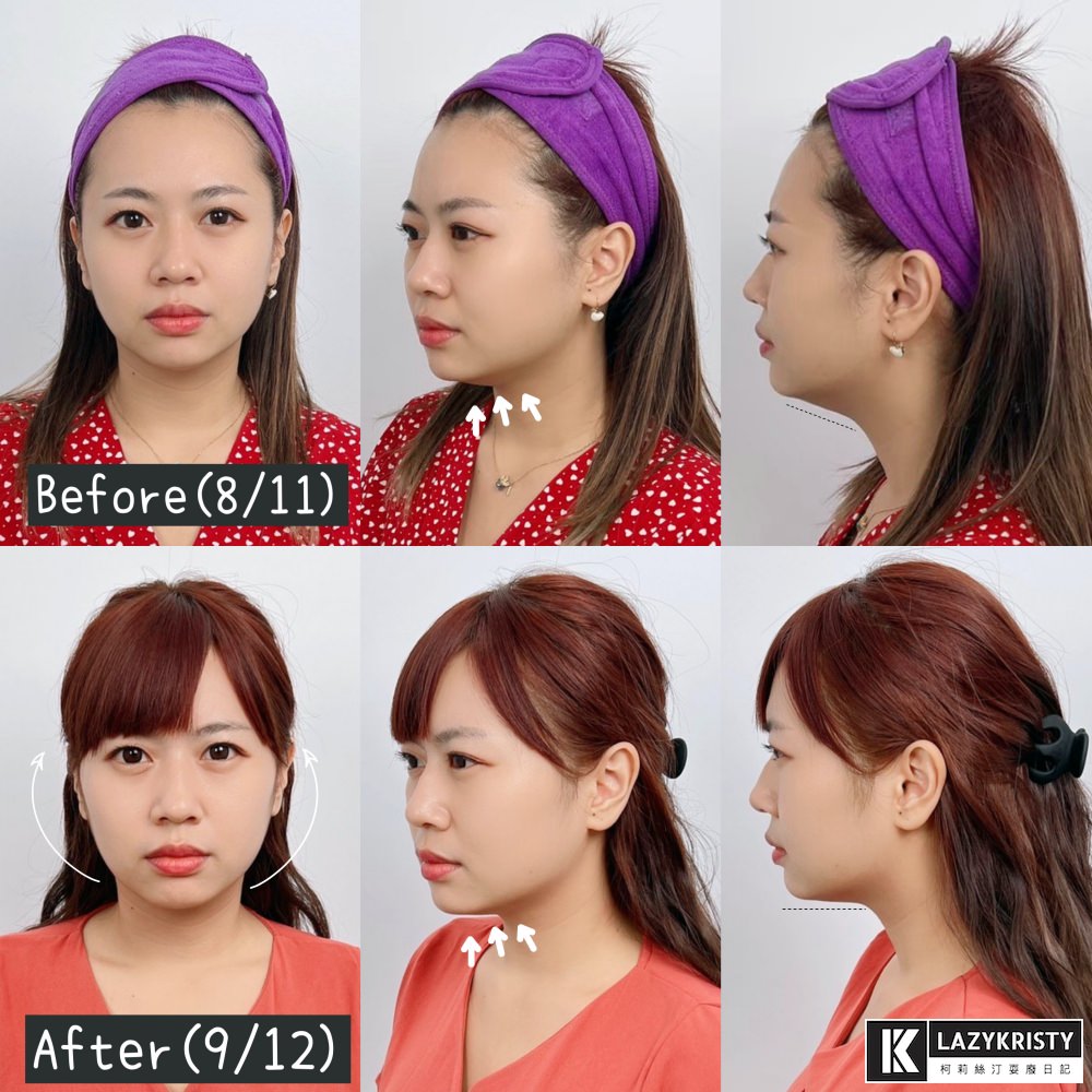 【滾開啦猖狂雙下巴】一招讓你找回消失的輪廓線！Q+立線音波拉提術後1個月多圖全紀錄