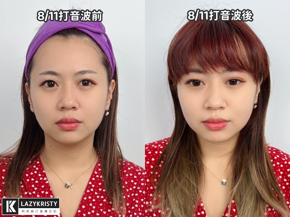 【滾開啦猖狂雙下巴】一招讓你找回消失的輪廓線！Q+立線音波拉提術後1個月多圖全紀錄