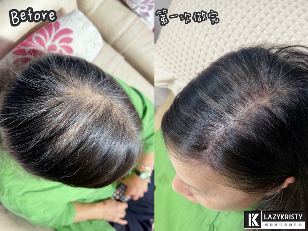 【禿頭落髮救星】不用植髮！無恢復期！3小時擁有茂密髮量～大推台北涵式紋繡的仿毛囊琇密術