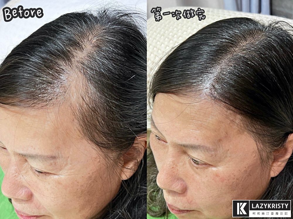 【禿頭落髮救星】不用植髮！無恢復期！3小時擁有茂密髮量～大推台北涵式紋繡的仿毛囊琇密術
