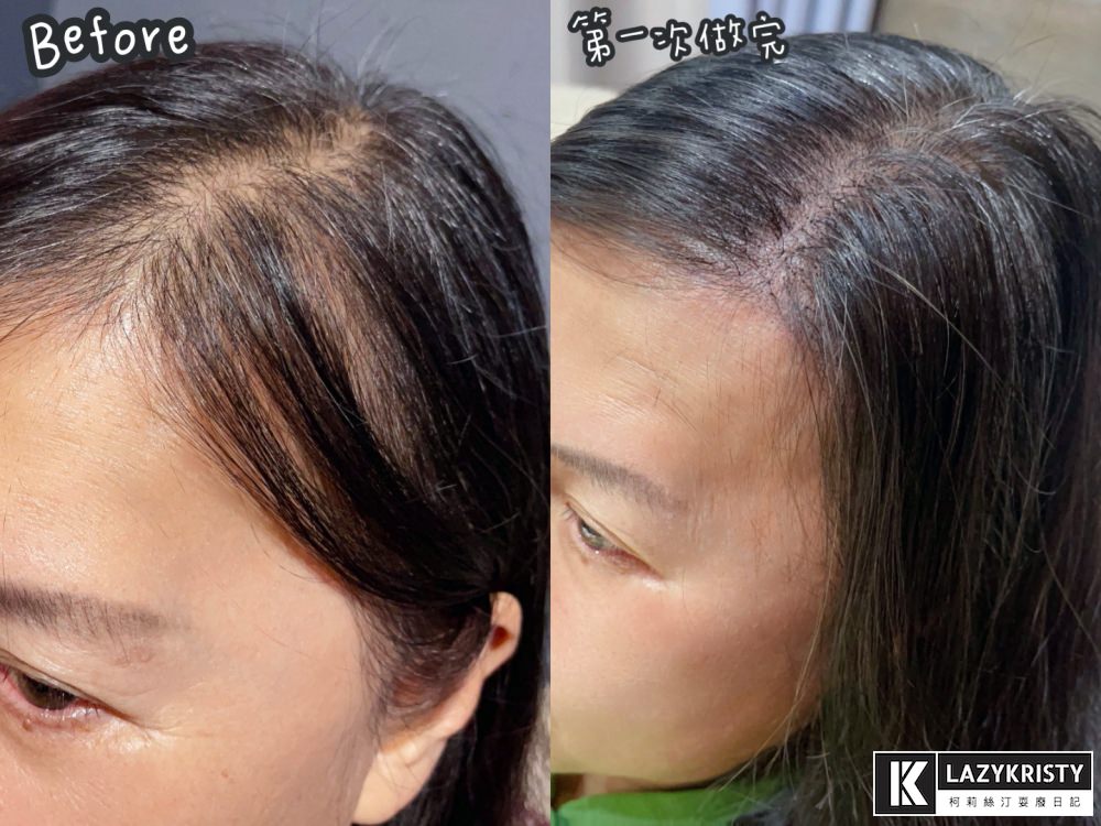 【禿頭落髮救星】不用植髮！無恢復期！3小時擁有茂密髮量～大推台北涵式紋繡的仿毛囊琇密術