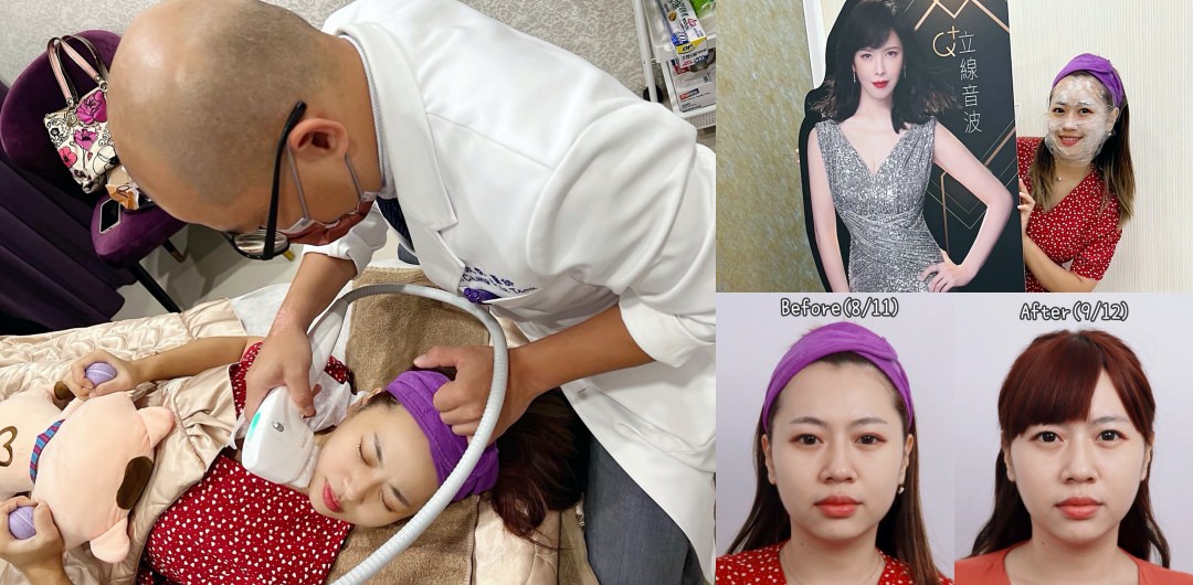 【滾開啦猖狂雙下巴】一招讓你找回消失的輪廓線！Q+立線音波拉提術後1個月多圖全紀錄