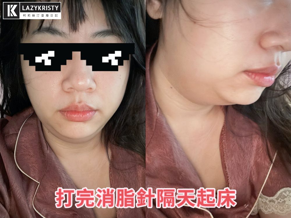 【不動刀消滅雙下巴醫美首選】打消脂針會痛嗎?消脂針會腫多久?(多圖完整紀錄)|台南美美上美診所 - 第17張圖 【不動刀消滅雙下巴醫美首選】打消脂針會痛嗎?消脂針會腫多久?(多圖完整紀錄)|台南美美上美診所