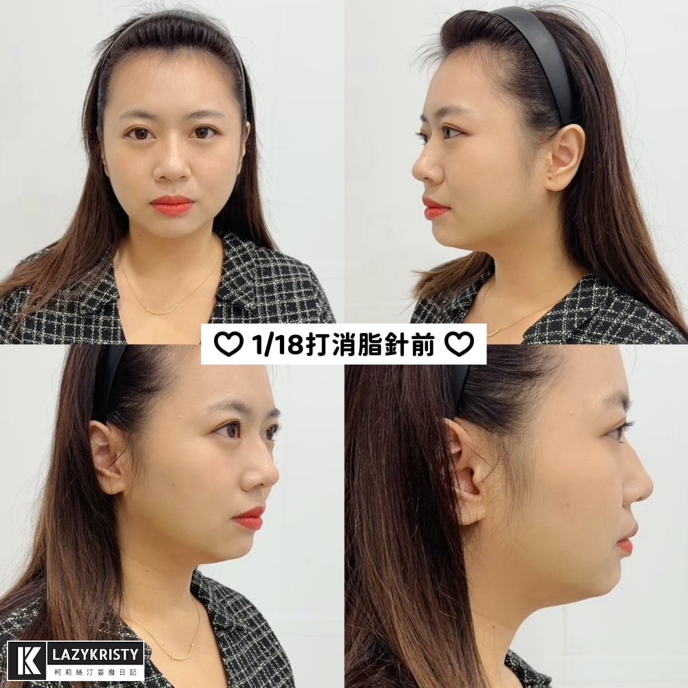 【不動刀消滅雙下巴醫美首選】打消脂針會痛嗎?消脂針會腫多久?(多圖完整紀錄)|台南美美上美診所 - 第13張圖 【不動刀消滅雙下巴醫美首選】打消脂針會痛嗎?消脂針會腫多久?(多圖完整紀錄)|台南美美上美診所