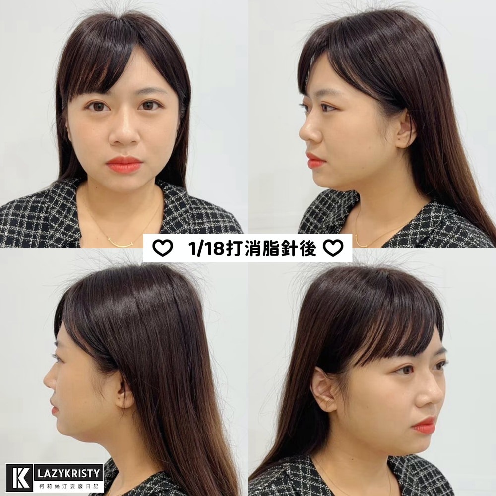 【不動刀消滅雙下巴醫美首選】打消脂針會痛嗎?消脂針會腫多久?(多圖完整紀錄)|台南美美上美診所 - 第14張圖 【不動刀消滅雙下巴醫美首選】打消脂針會痛嗎?消脂針會腫多久?(多圖完整紀錄)|台南美美上美診所