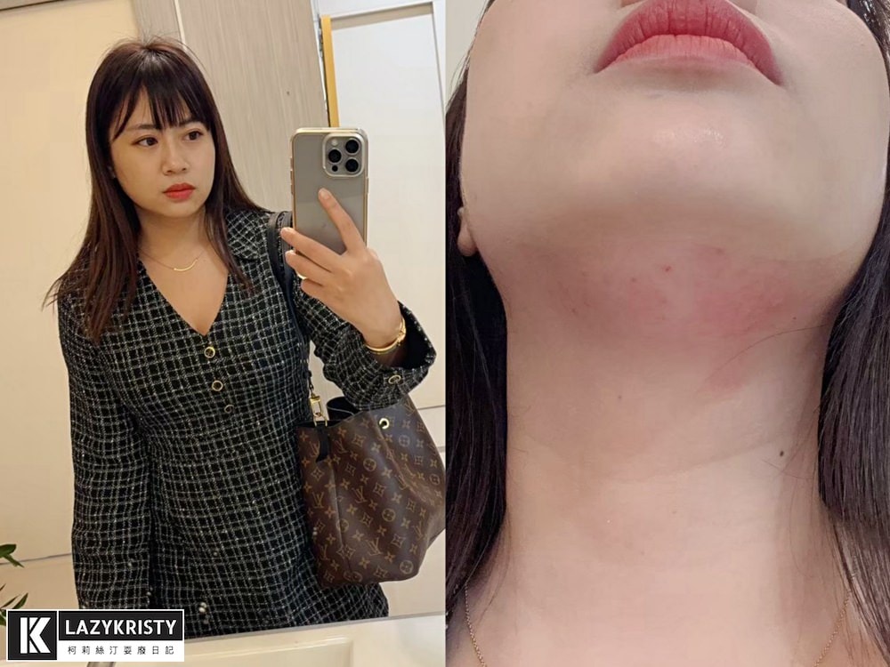 【不動刀消滅雙下巴醫美首選】打消脂針會痛嗎?消脂針會腫多久?(多圖完整紀錄)|台南美美上美診所 - 第15張圖 【不動刀消滅雙下巴醫美首選】打消脂針會痛嗎?消脂針會腫多久?(多圖完整紀錄)|台南美美上美診所