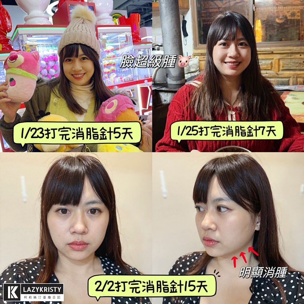 【不動刀消滅雙下巴醫美首選】打消脂針會痛嗎?消脂針會腫多久?(多圖完整紀錄)|台南美美上美診所 - 第18張圖 【不動刀消滅雙下巴醫美首選】打消脂針會痛嗎?消脂針會腫多久?(多圖完整紀錄)|台南美美上美診所