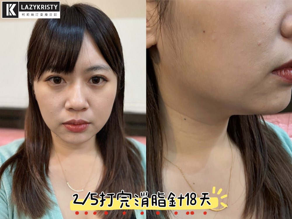 【不動刀消滅雙下巴醫美首選】打消脂針會痛嗎?消脂針會腫多久?(多圖完整紀錄)|台南美美上美診所 - 第19張圖 【不動刀消滅雙下巴醫美首選】打消脂針會痛嗎?消脂針會腫多久?(多圖完整紀錄)|台南美美上美診所