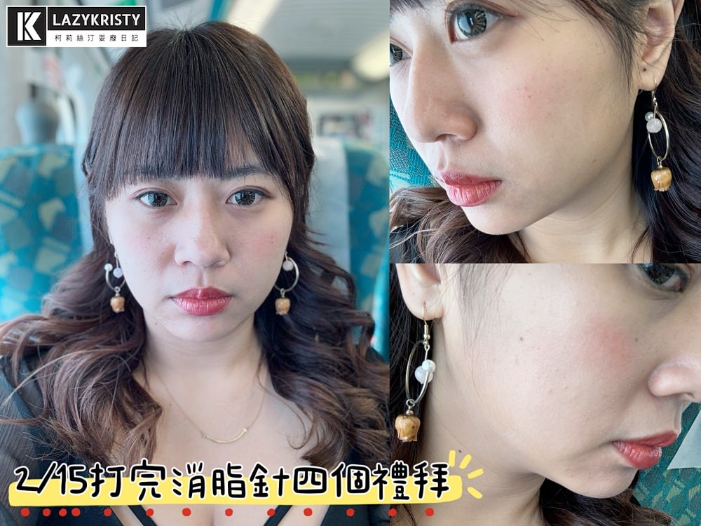 【不動刀消滅雙下巴醫美首選】打消脂針會痛嗎?消脂針會腫多久?(多圖完整紀錄)|台南美美上美診所 - 第21張圖 【不動刀消滅雙下巴醫美首選】打消脂針會痛嗎?消脂針會腫多久?(多圖完整紀錄)|台南美美上美診所