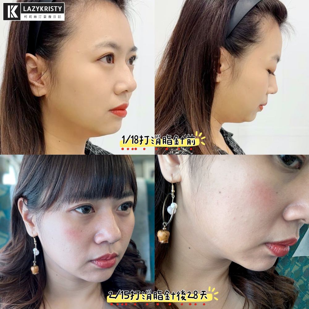 【不動刀消滅雙下巴醫美首選】打消脂針會痛嗎?消脂針會腫多久?(多圖完整紀錄)|台南美美上美診所 - 第22張圖 【不動刀消滅雙下巴醫美首選】打消脂針會痛嗎?消脂針會腫多久?(多圖完整紀錄)|台南美美上美診所