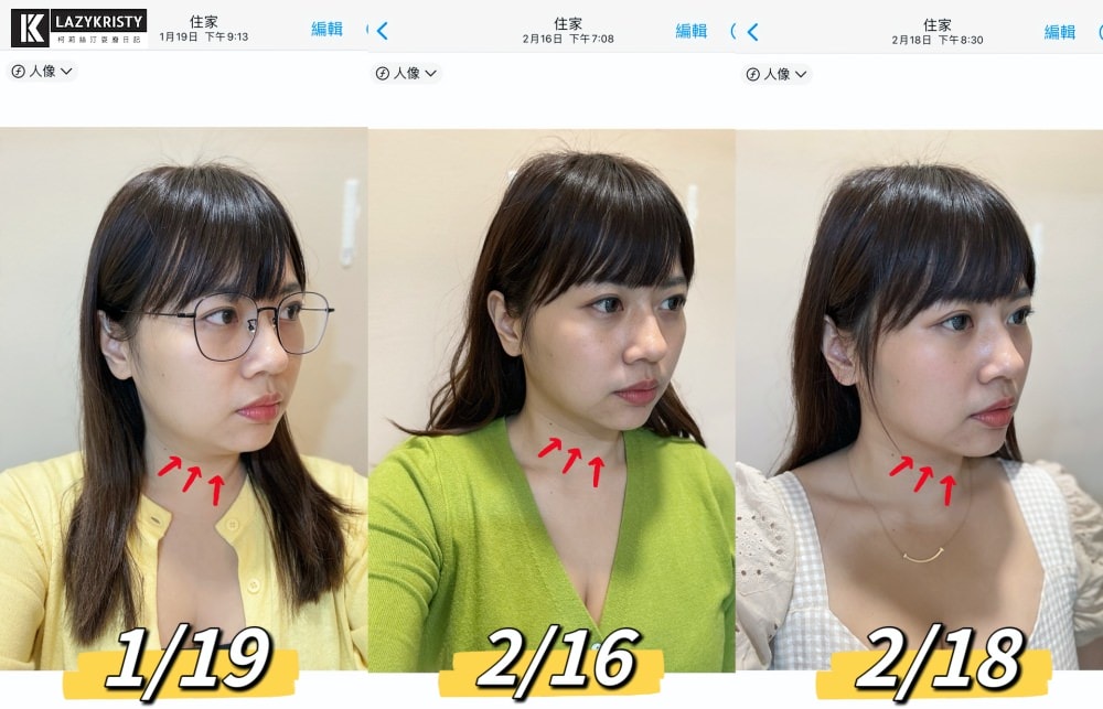 【不動刀消滅雙下巴醫美首選】打消脂針會痛嗎?消脂針會腫多久?(多圖完整紀錄)|台南美美上美診所 - 第23張圖 【不動刀消滅雙下巴醫美首選】打消脂針會痛嗎?消脂針會腫多久?(多圖完整紀錄)|台南美美上美診所