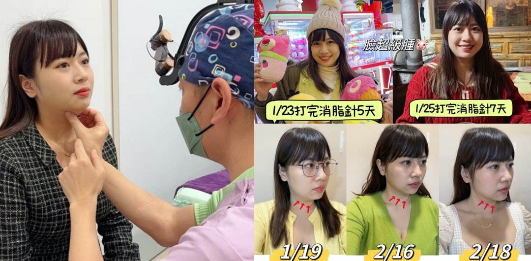 【不動刀消滅雙下巴醫美首選】打消脂針會痛嗎?消脂針會腫多久?(多圖完整紀錄)|台南美美上美診所 - 第1張圖 【不動刀消滅雙下巴醫美首選】打消脂針會痛嗎?消脂針會腫多久?(多圖完整紀錄)|台南美美上美診所